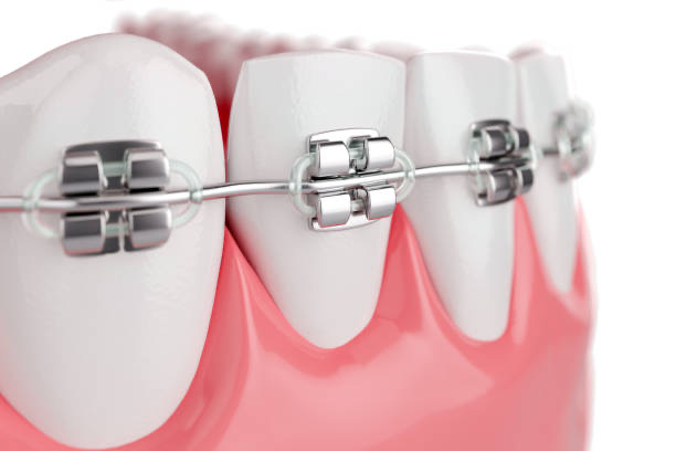 Dental Braces Adelaide