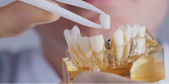 dental implants Adelaide